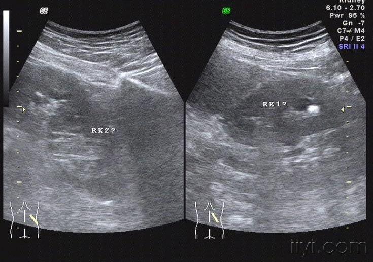 重复肾超声表现图片图片