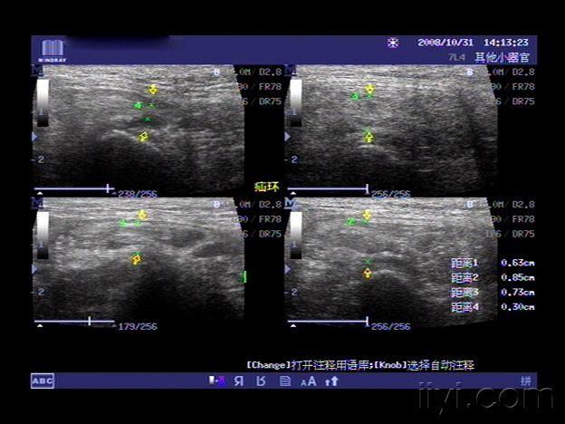 腹股沟斜疝彩超图片图片