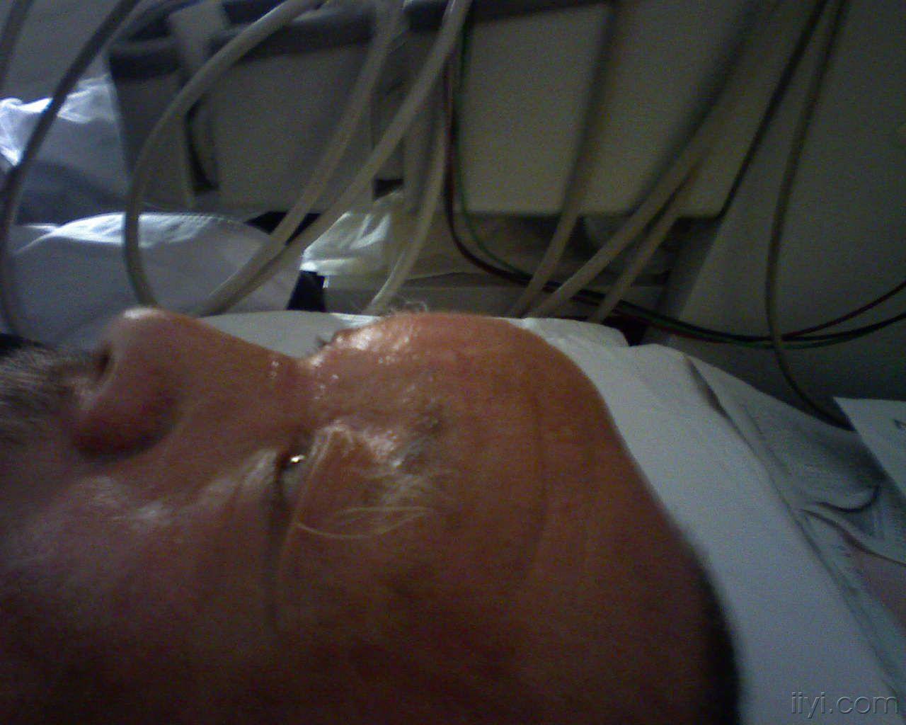 过敏性水肿包块?第一次见!