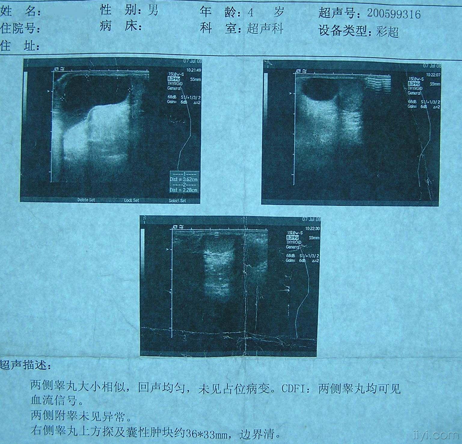 正常 我的兒子3周8個月大,3個月前發現得了交通性睪丸鞘膜積液(右側