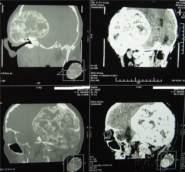 罕见颅骨骨瘤