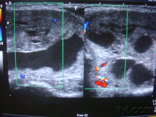 超声诊断:甲状腺囊腺瘤.