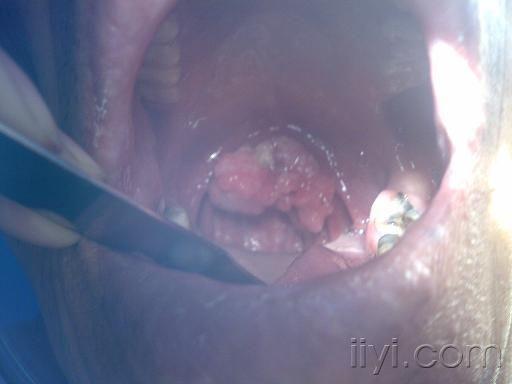 小舌头乳头状瘤图片