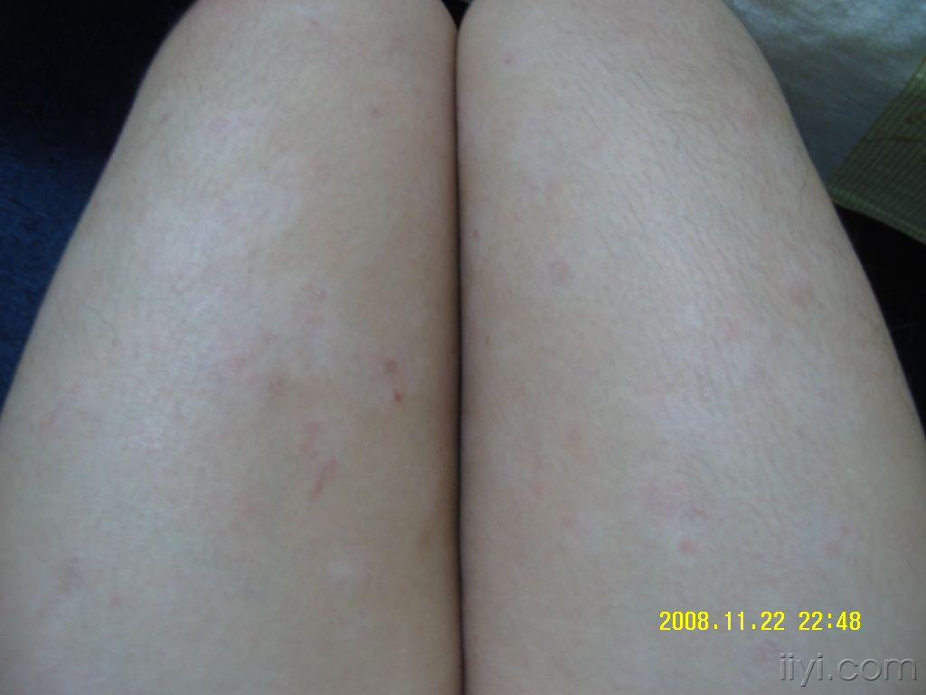 上覆少量鳞屑,后逐渐变大,变白,成为边界清楚的色素减退斑,上覆少量