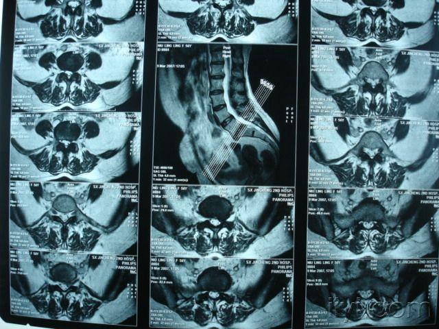 腰4,5腰5骶1椎間盤突出.腰5滑脫.