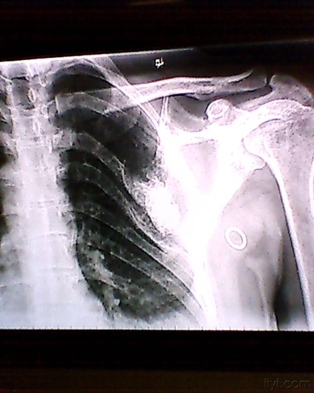 肩胛骨肿瘤早期症状图片