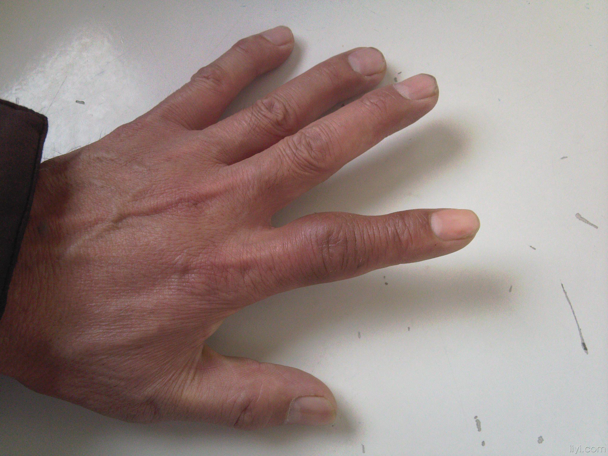 尿酸高手指肿图片图片