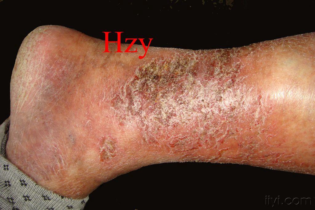 楼主236373582008-12-11 11:12:10请诊断  公布答案,淤积性皮炎,皮脂