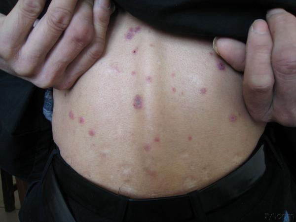 梅毒二期皮疹图初期图片