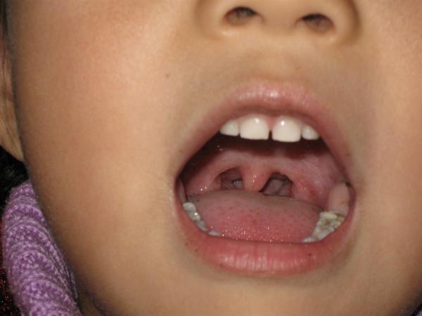 孩子喉咙发白图片图片