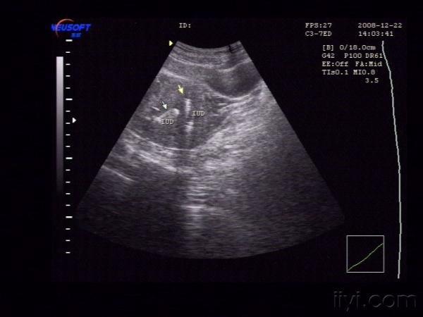 宫内节育环超声图片图片