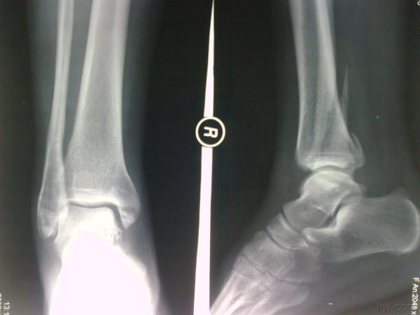 踝关节骨折脱位 的分型(术前术后对比)
