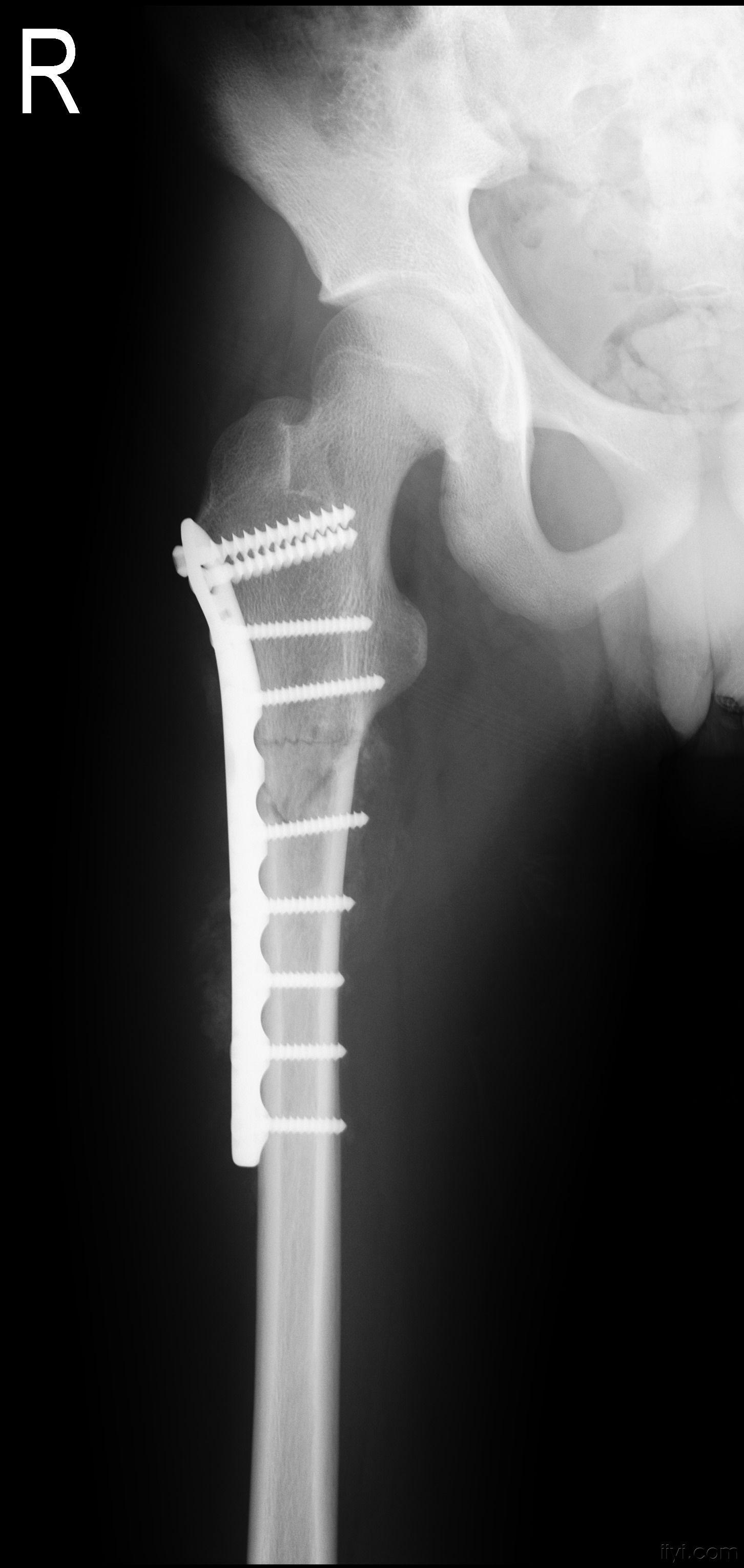 股骨基底骨折图片图片