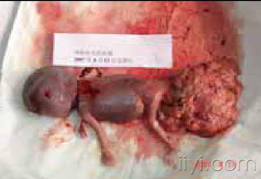 胎儿骶尾部畸胎瘤图片图片
