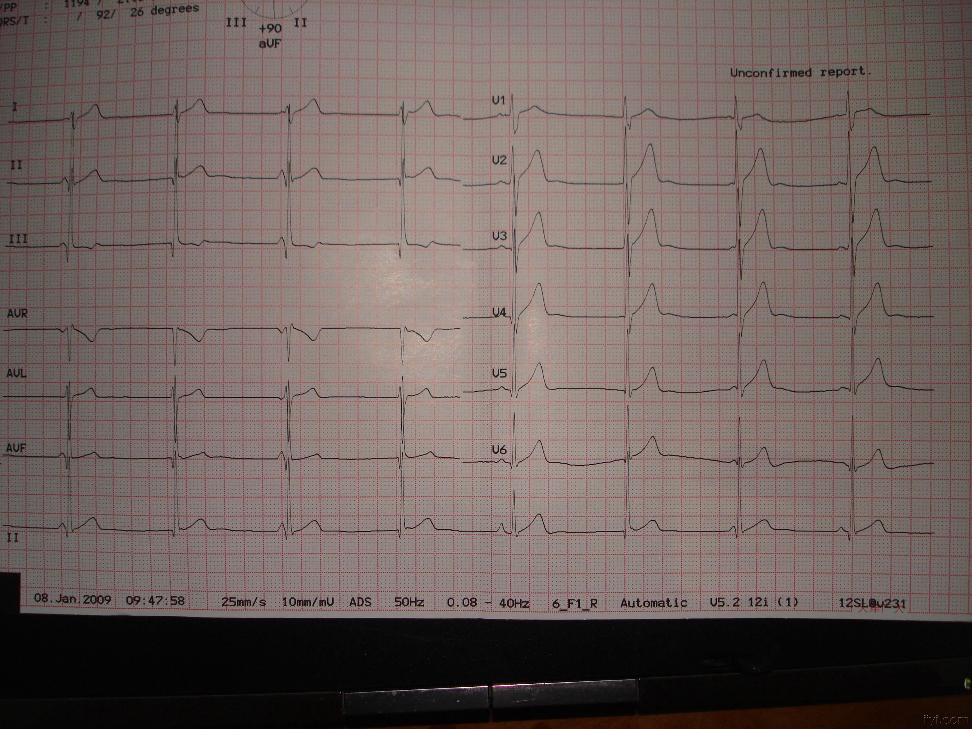 新兵体检好怪异的心电图