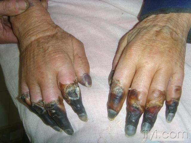 手指皮肤坏死图片