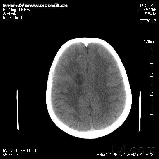 一个八岁,一个二十分岁都是外伤后做ct检查,发现右侧脑实质内略低密度