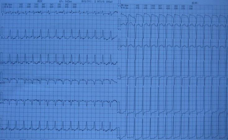 2:1房扑还是室上速