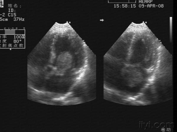 典型病例 --左房粘液瘤 - 超声医学讨论版 - 爱爱医医学论坛 - 爱爱医
