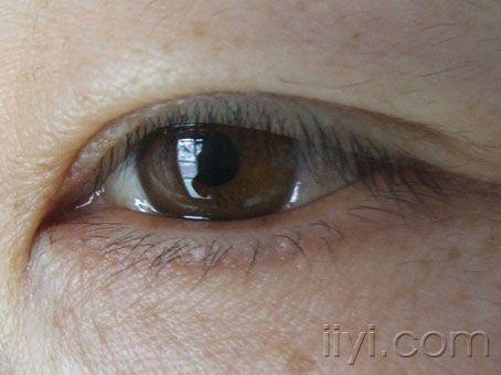 眼睛球结膜水肿的图片图片
