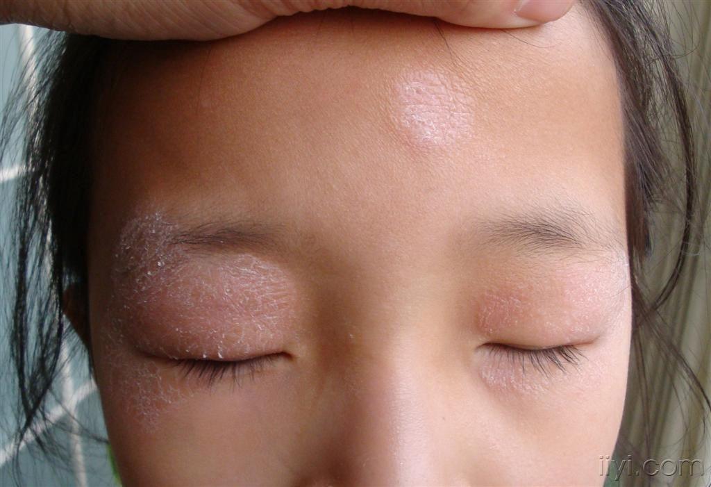 请大家看看小儿面部皮损如何诊治 - 皮肤及性传播疾病讨论版 - 爱爱医