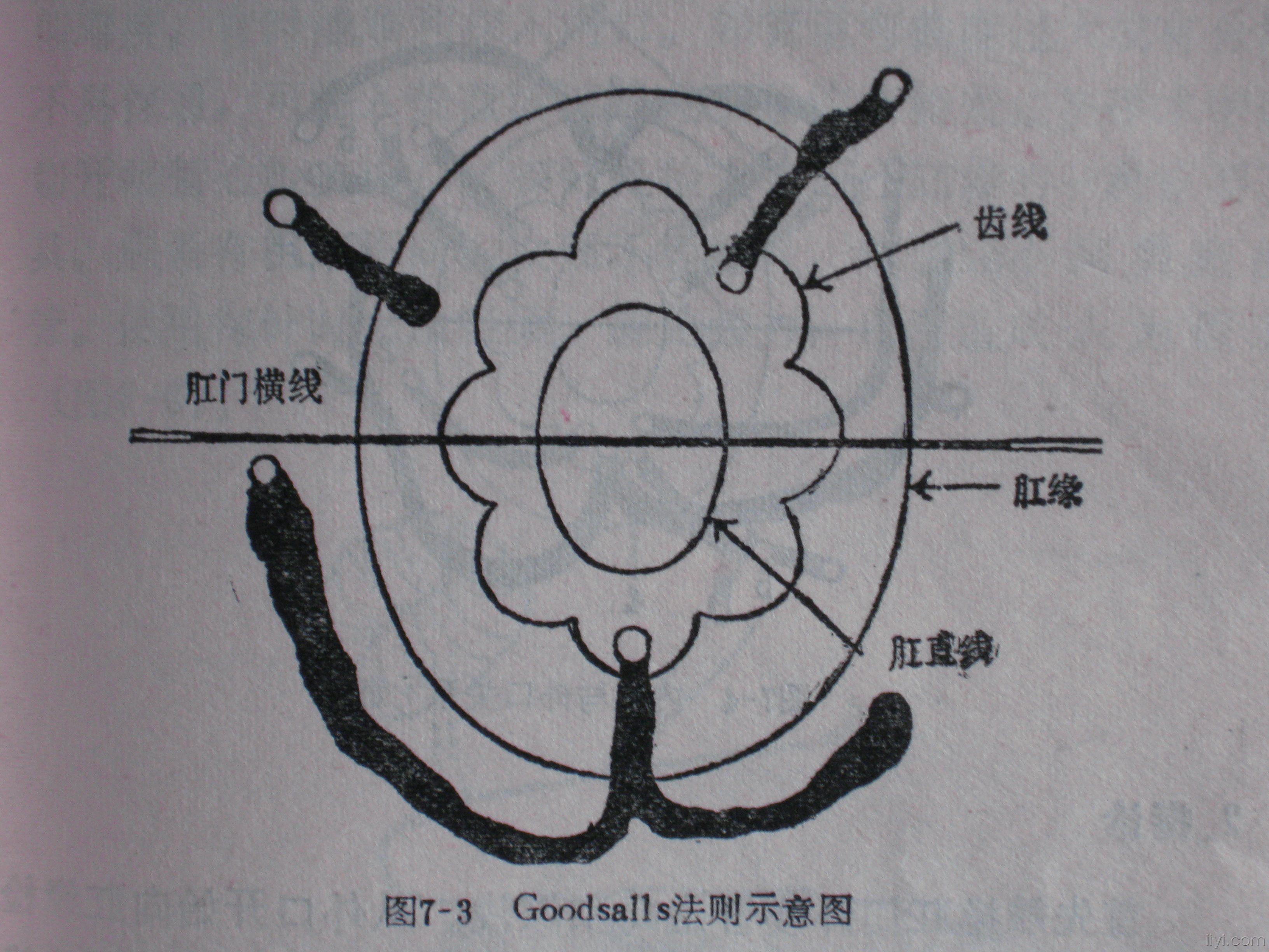 半马蹄形肛瘘图片