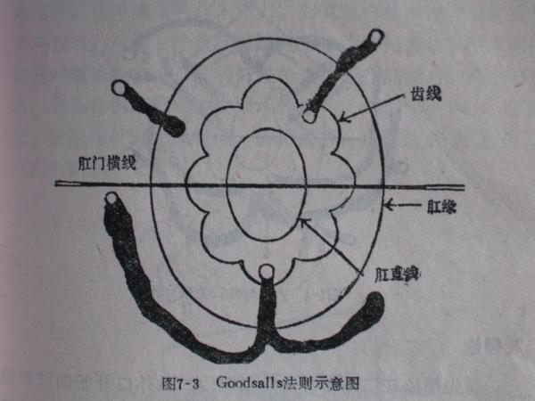 半马蹄肛瘘图图片