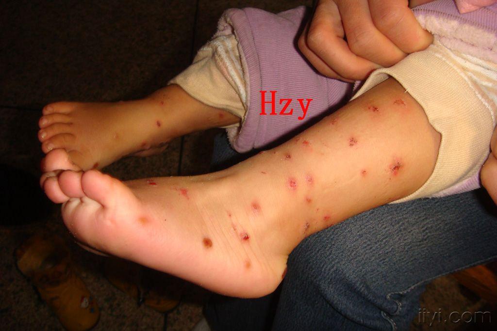 去四川家乡半个月,回来便成这样,有人说水土不服.