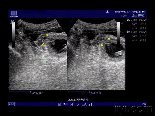 尿道下裂超声图片