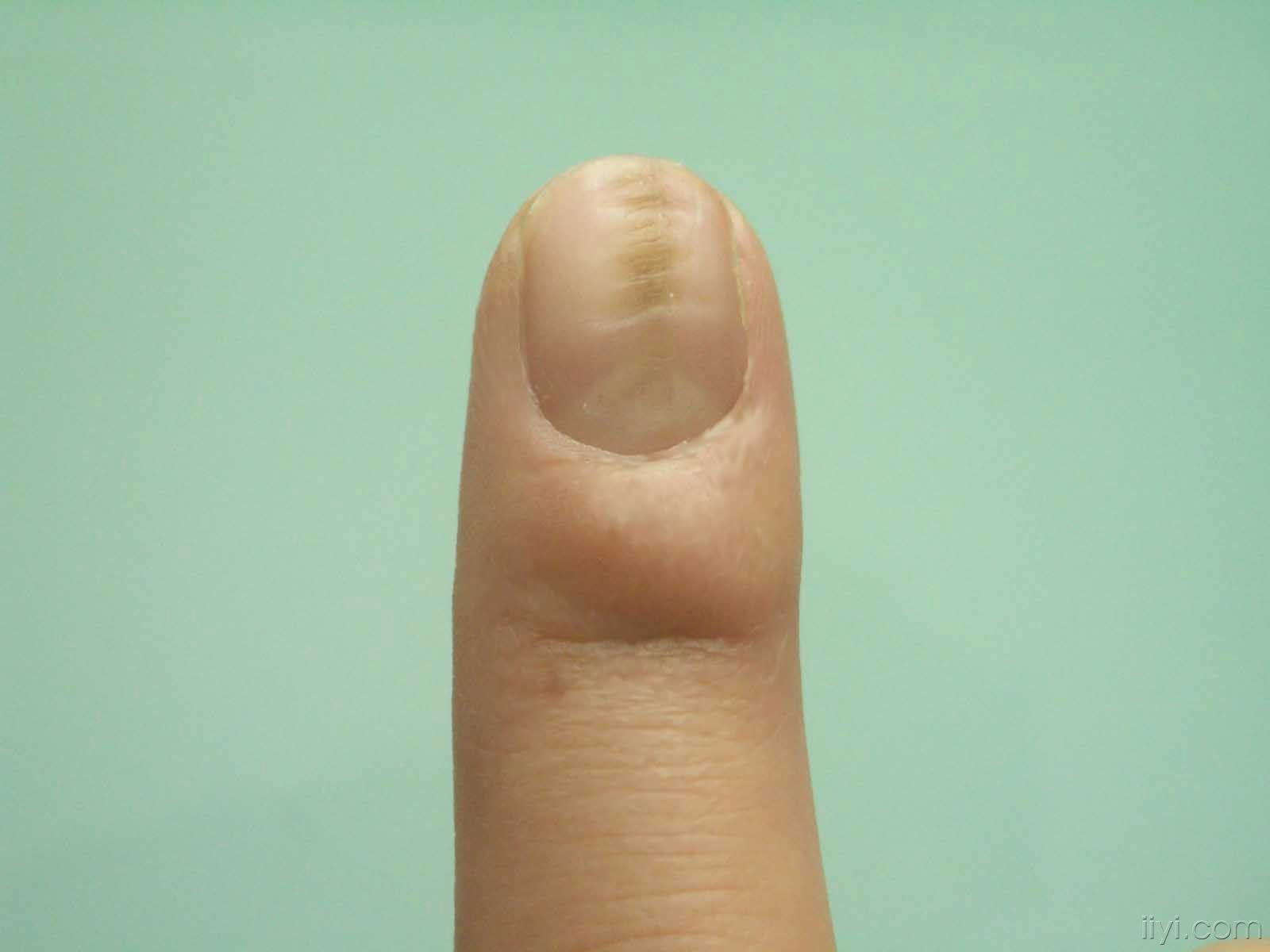 两只手的食指指甲都这样,是什么原因啊?
