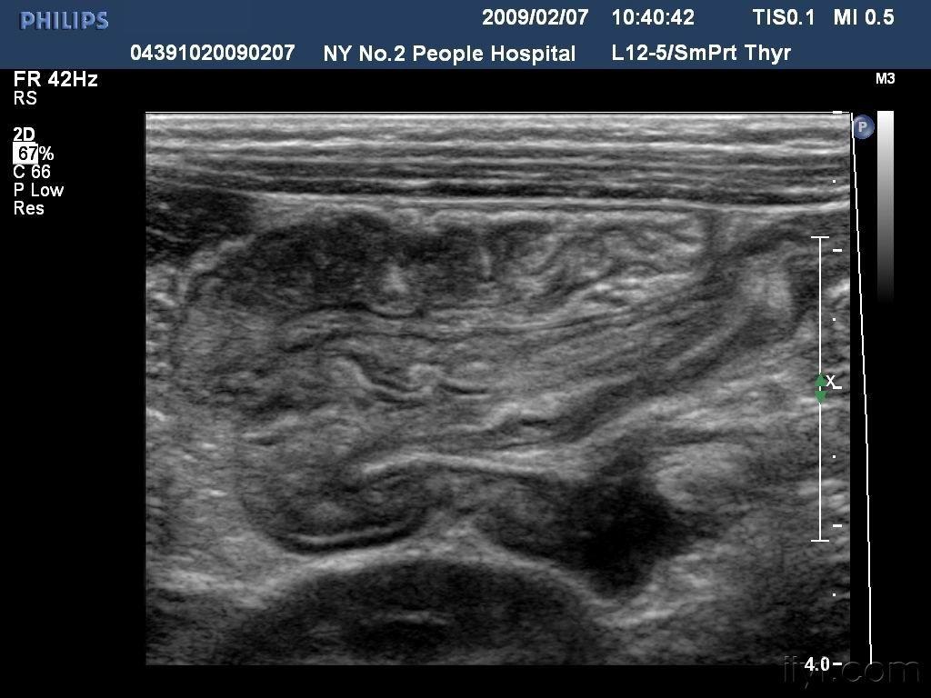 【贴图】肠套叠 - 超声医学讨论版 - 爱爱医医学论坛 - 爱爱医医学网