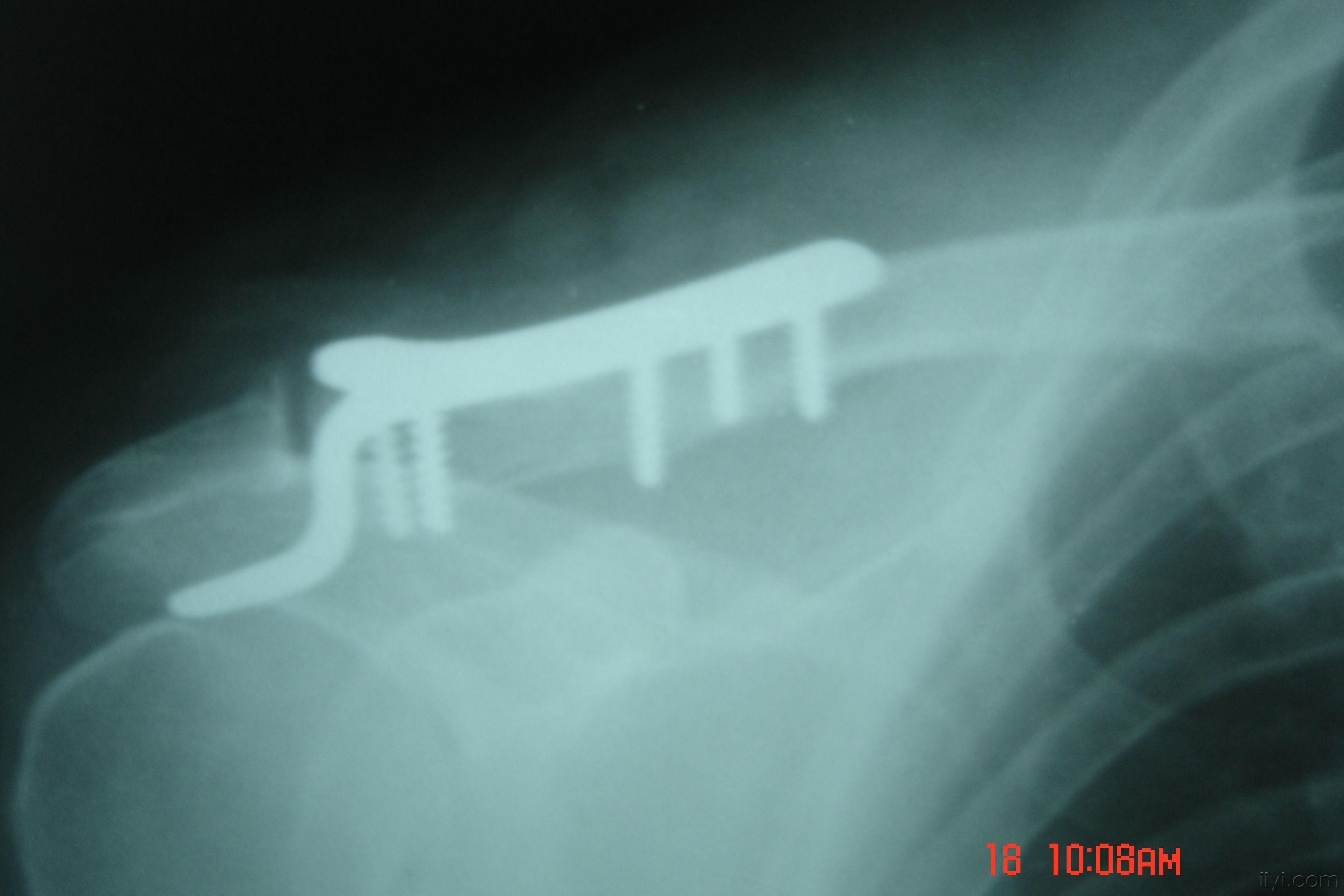 锁骨肩峰端骨折,第一次使用钩钢板手术