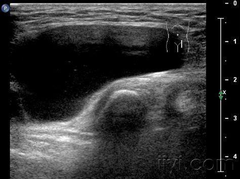【急会诊】腹股沟区包块(出结果了32楼)