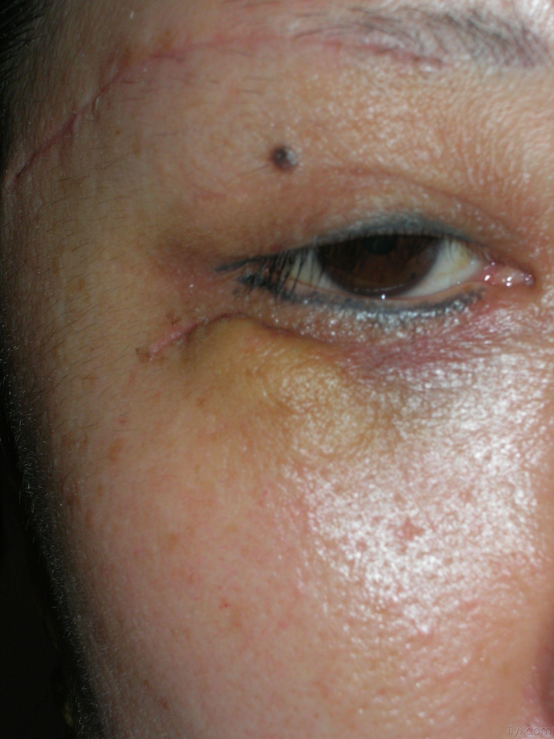 外切眼袋疤痕增生图片图片