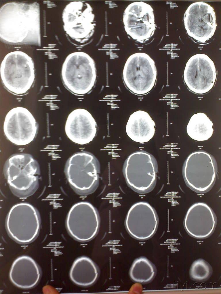 一例颅脑损伤的病例!请过脑外科博士读片指导解难(有最新进展了!).