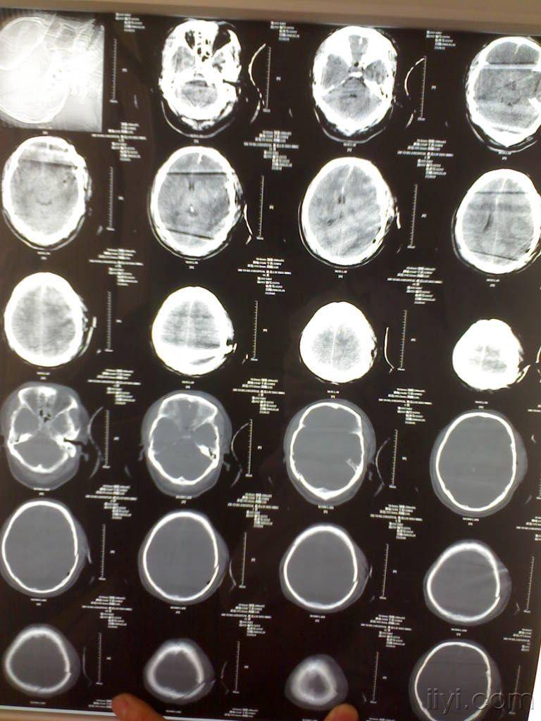 请过脑外科博士读片指导解难(有最新进展了!).