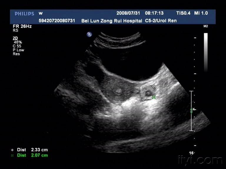楼主wwybl2009-03-30 22:10:45子宫前位,长径约52mm,宽约42mm,厚约