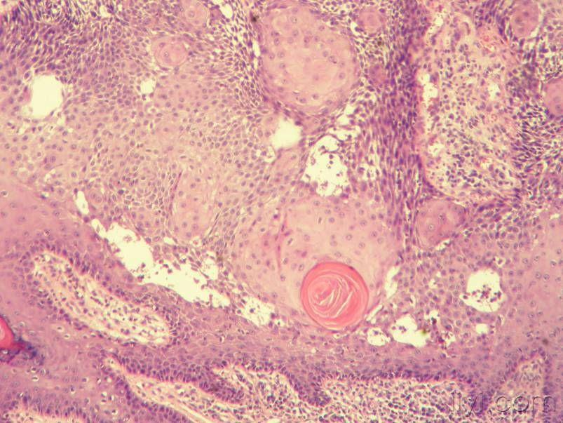 日光性角化病理图片图片