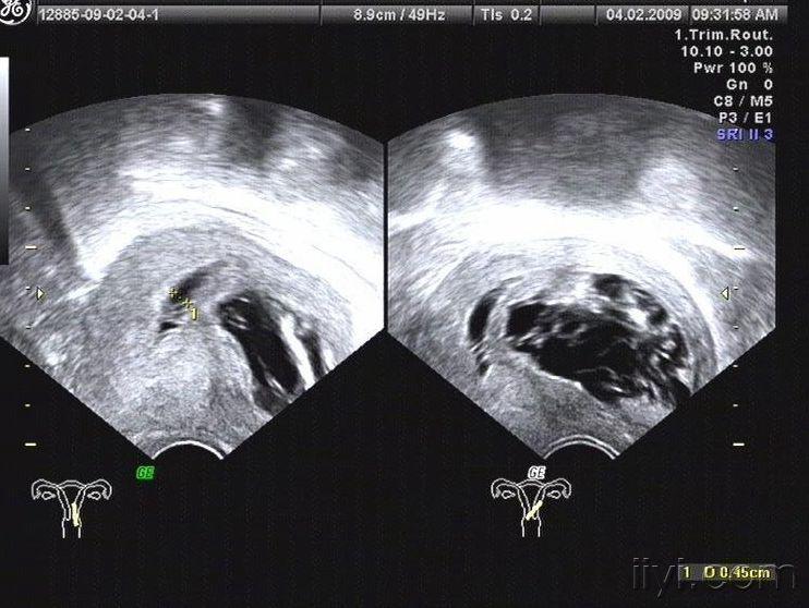 子宫肌瘤玻璃样变超声图片