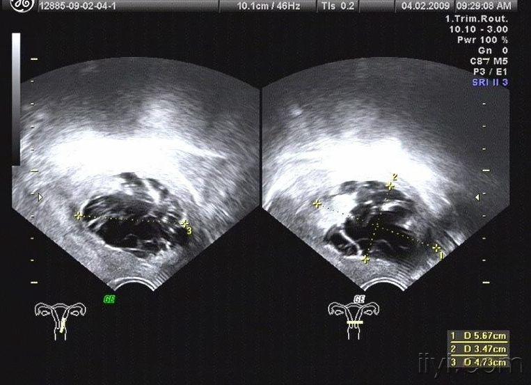 子宫肌瘤玻璃样变超声图片