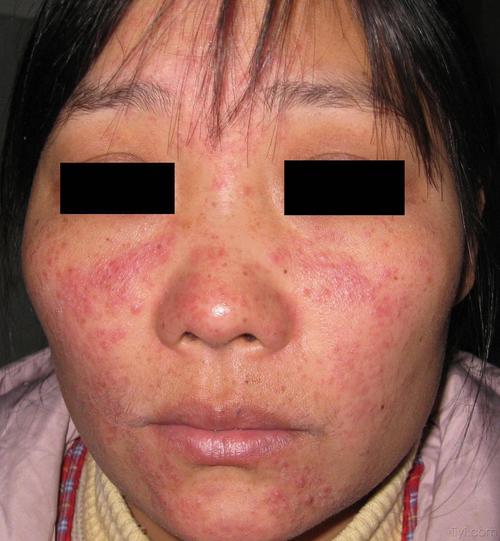 毛囊虫皮炎图片 - 皮肤及性传播疾病讨论版 - 爱爱医医学论坛 - 爱爱