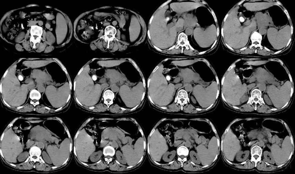 胰腺占位!请讨论!