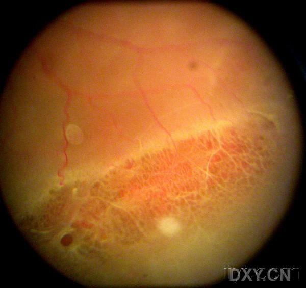 格子样视网膜变性