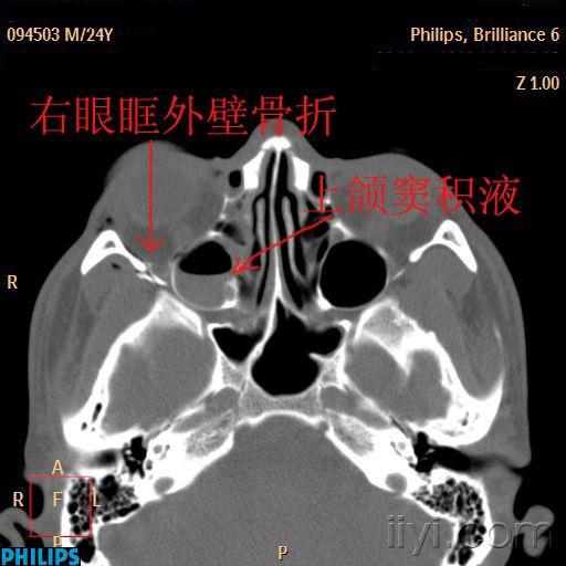 眼,鼻,上颌窦等的骨折,要慢慢的,小心的看喔