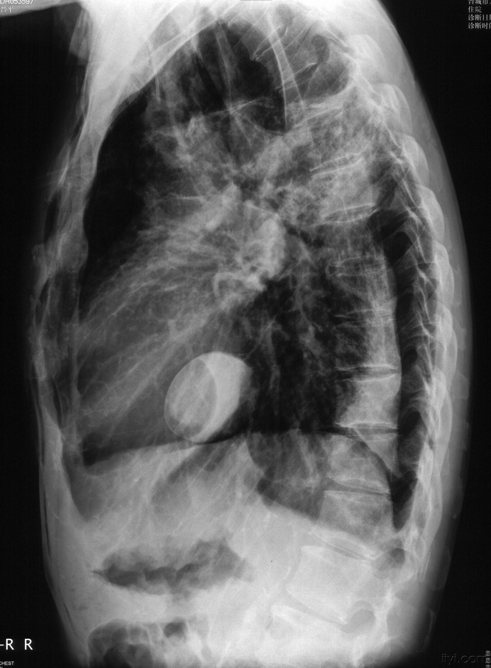 肺大疱x线图片