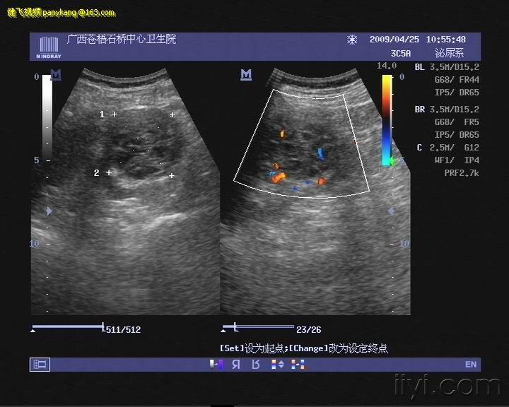 肾癌超声图片