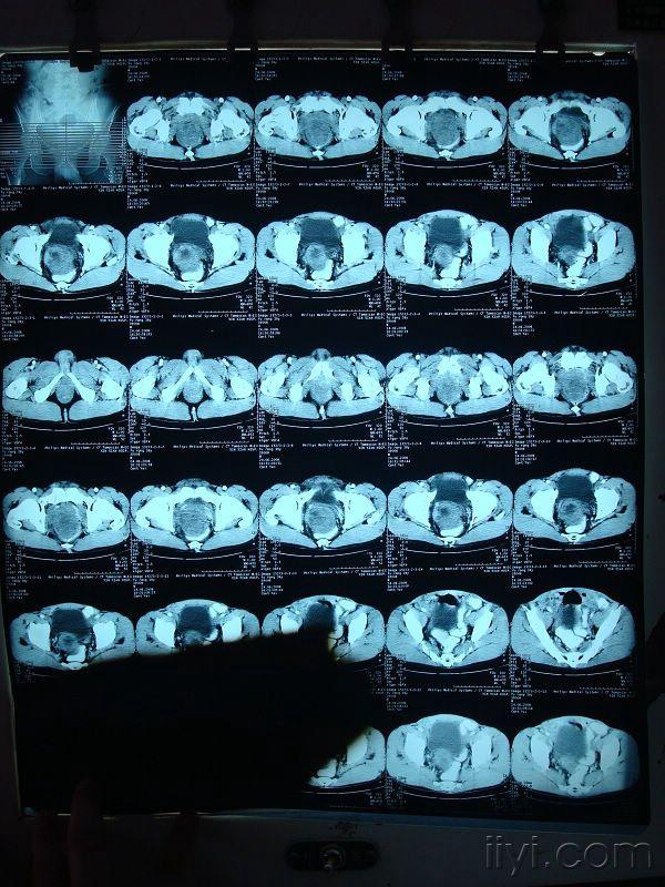 前列腺增生CT图片