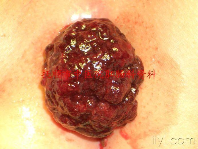 绒毛状管状腺瘤图片