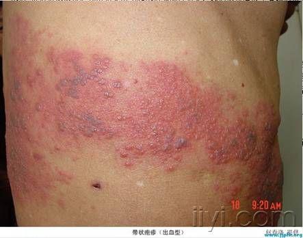足部带状疱疹
