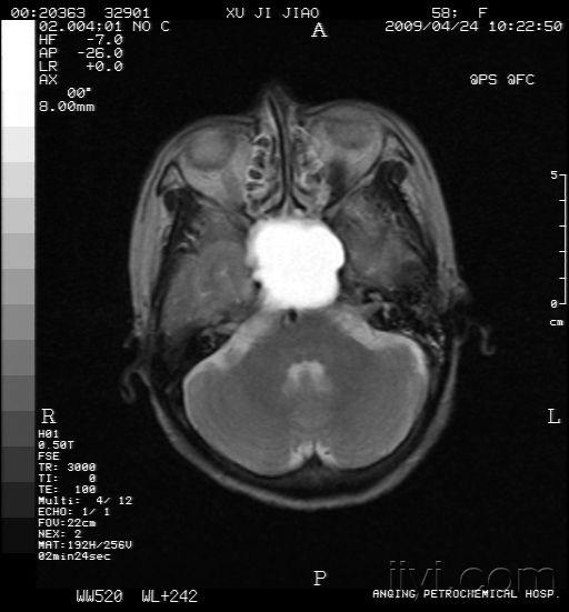 蝶窦病变,我的诊断可脑外科主任不同,请各位高手指点一下